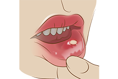 粘液嚢胞（ねんえきのうほう）