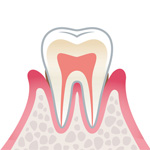 歯周病の進行度