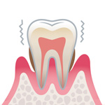 歯周病の進行度